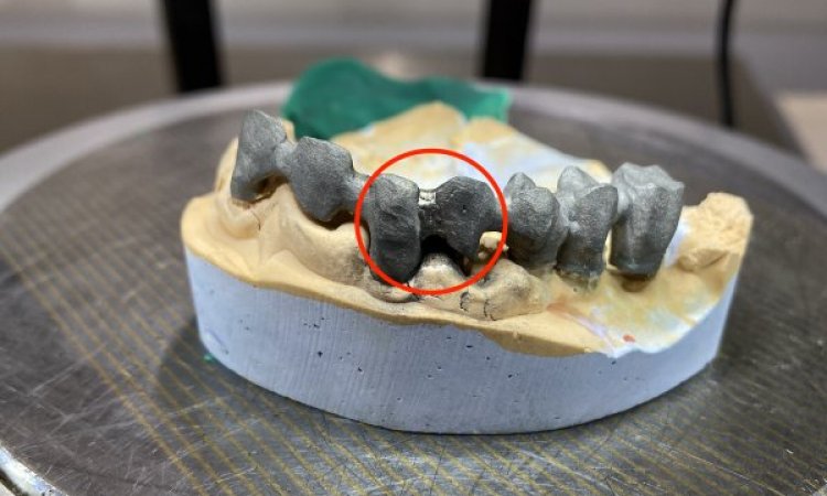 Soudure laser sur appareillage dentaire. livraison dans toute la France : Marseille Lyon Paris 